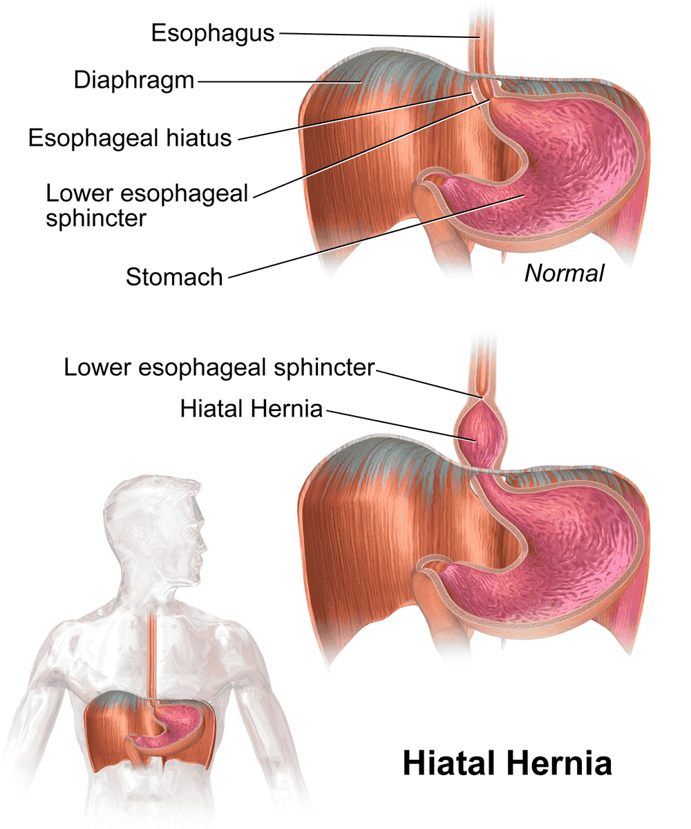 Hernia hiatal Hernia hiatal